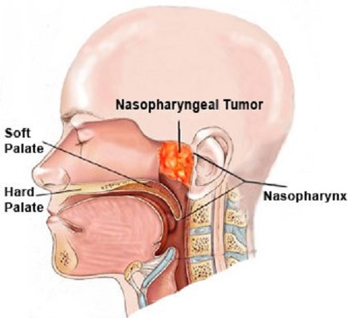 nasopharyngeal carcinoma