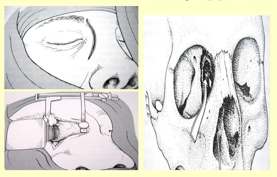 patterson external ethmoidectomy