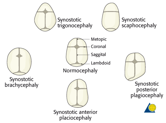 craniofacial anomalies