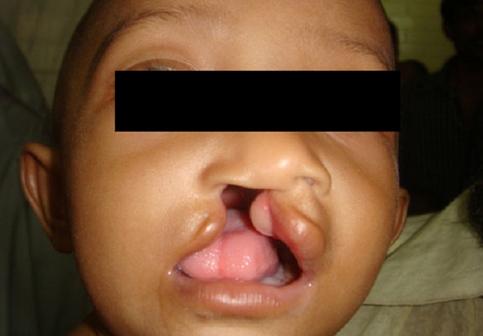 Cleft lip
